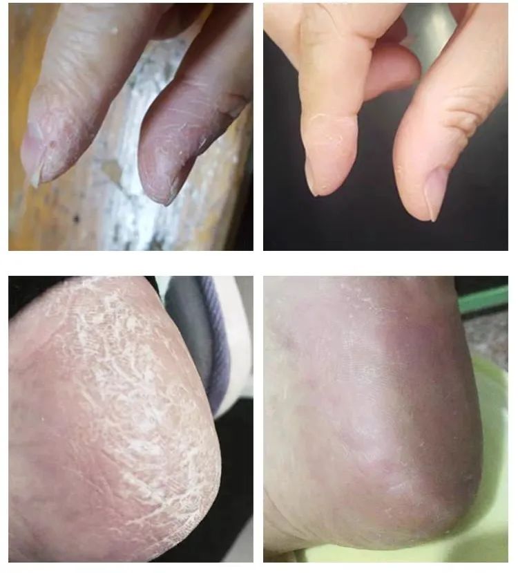 脚跟开裂,老茧,死皮……又疼又丑!用它一抹,双脚嫩滑,实测惊呆了!
